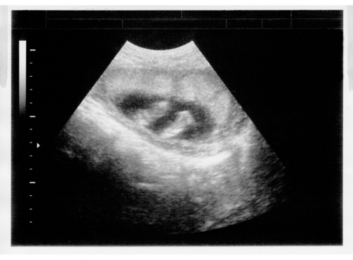 Ultrasound